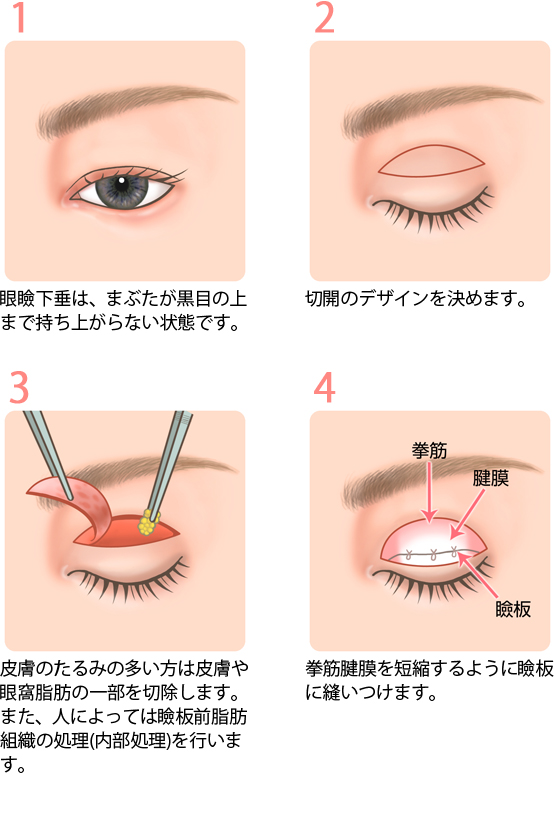 眼瞼下垂症の手術方法1