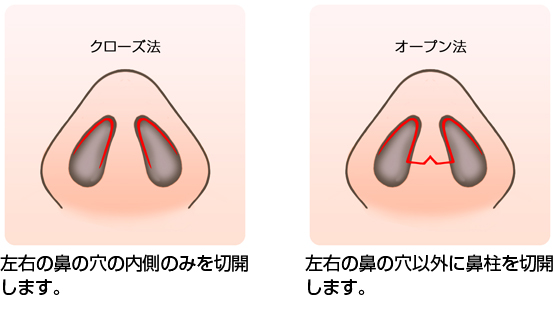 だんご鼻の手術の方法1