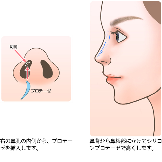 プロテーゼ挿入(医療用シリコン)による隆鼻術