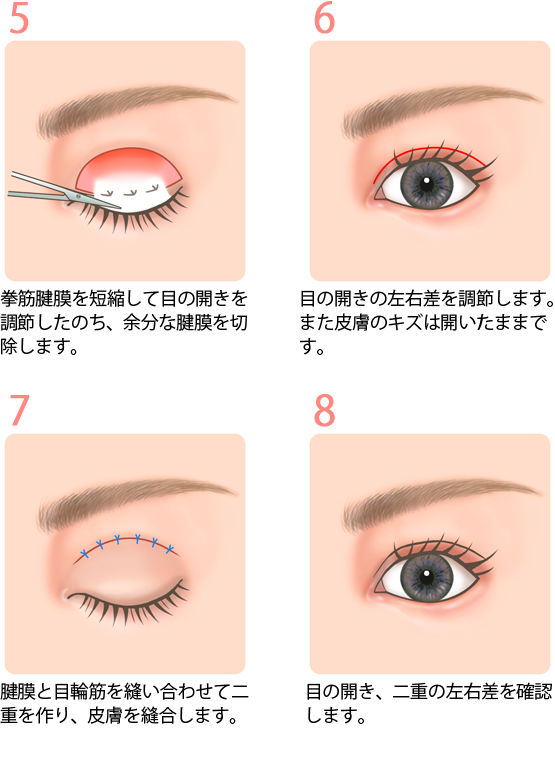 眼瞼下垂症の手術方法2