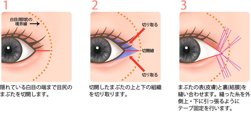 目尻切開術の手術方法