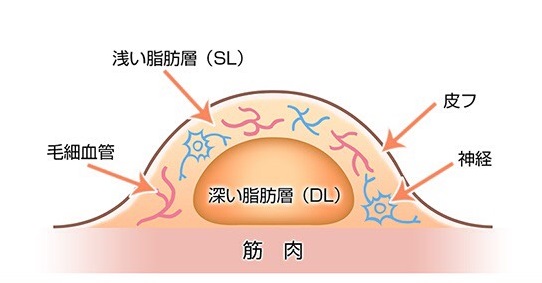 脂肪吸引4