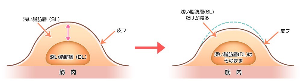脂肪吸引5
