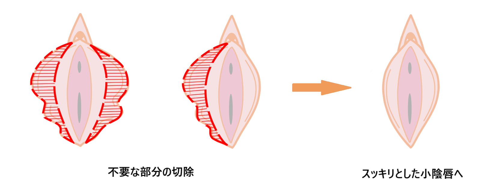 小陰唇縮小の手術イメージ