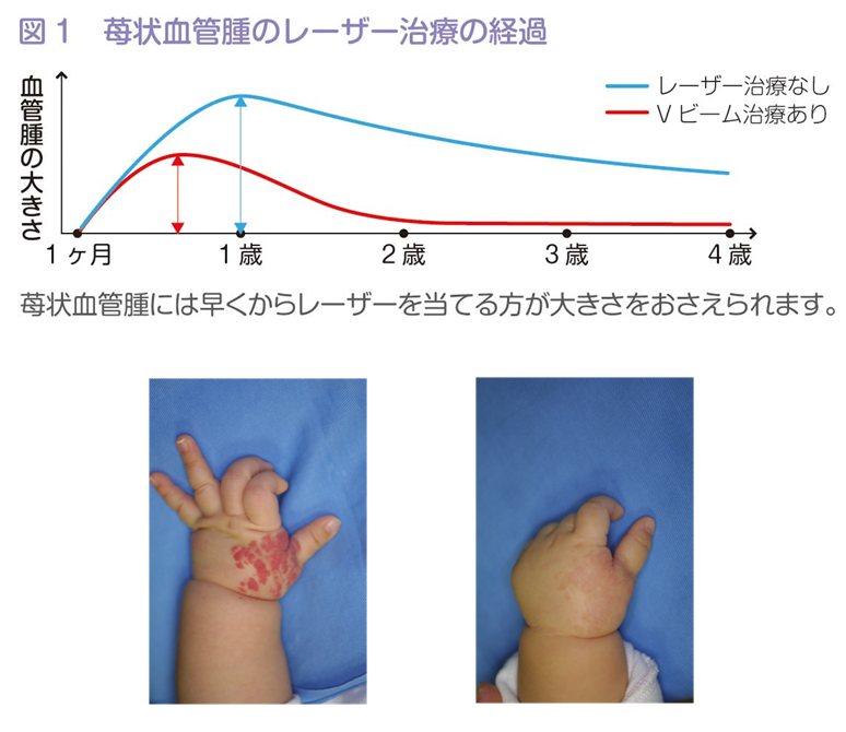 苺状血管腫のレーザー治療の経過