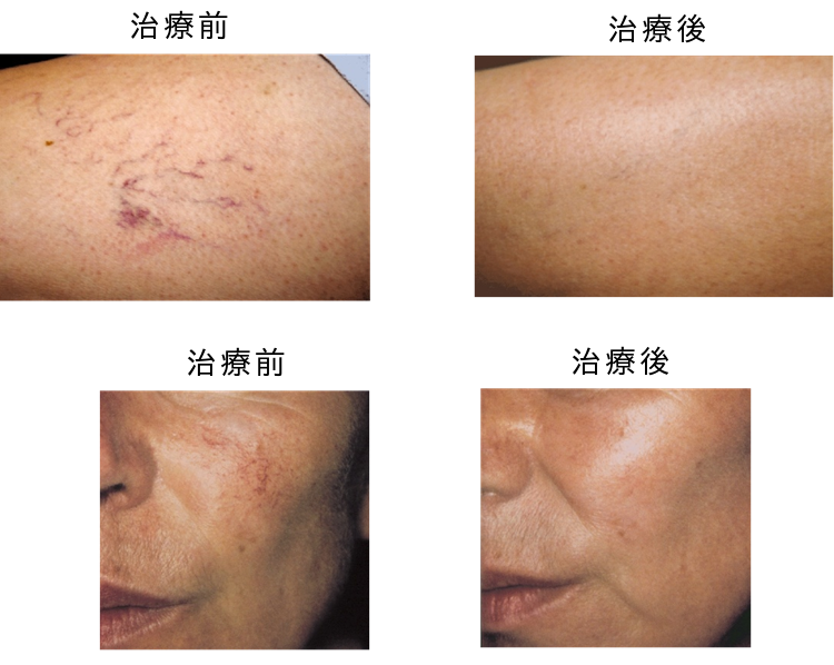 赤あざ毛細血管拡張症の治療前後