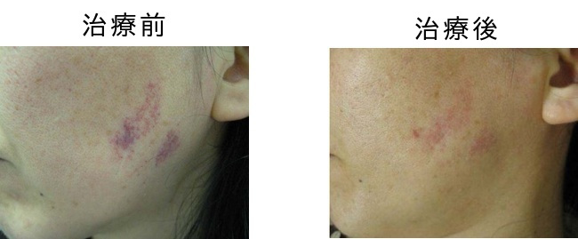 単純性血管腫のVビーム治療前後