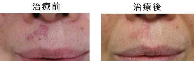 単純性血管腫のVビーム治療前後