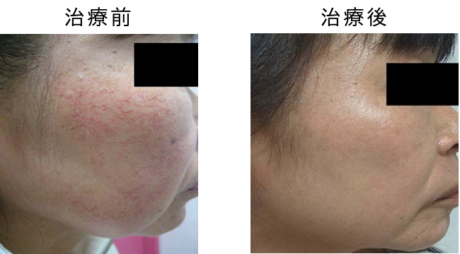 赤あざ毛細血管拡張症の治療前後