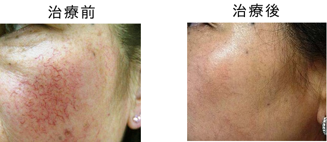 赤あざ毛細血管拡張症の治療前後