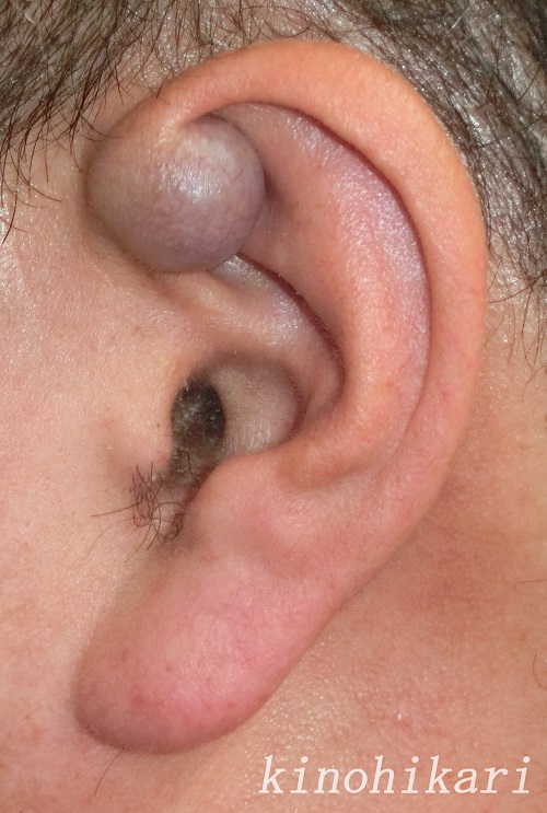 耳介腫瘍