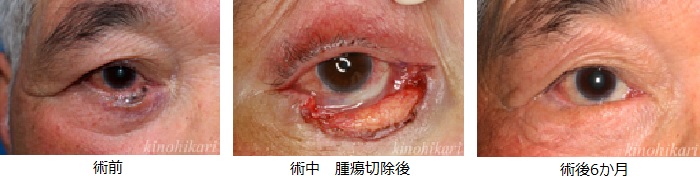 眼瞼下垂症の症例8