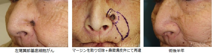 外鼻の腫瘍