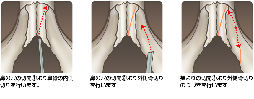 鼻骨骨切り術の手術方法