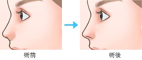 鼻孔縁挙上術T型