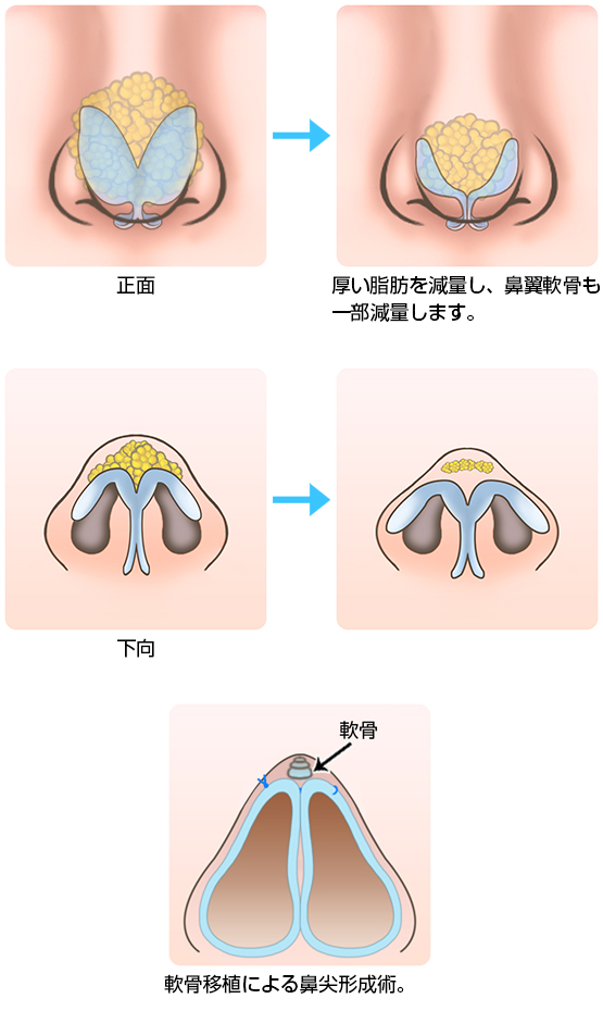 だんご鼻の手術の方法2