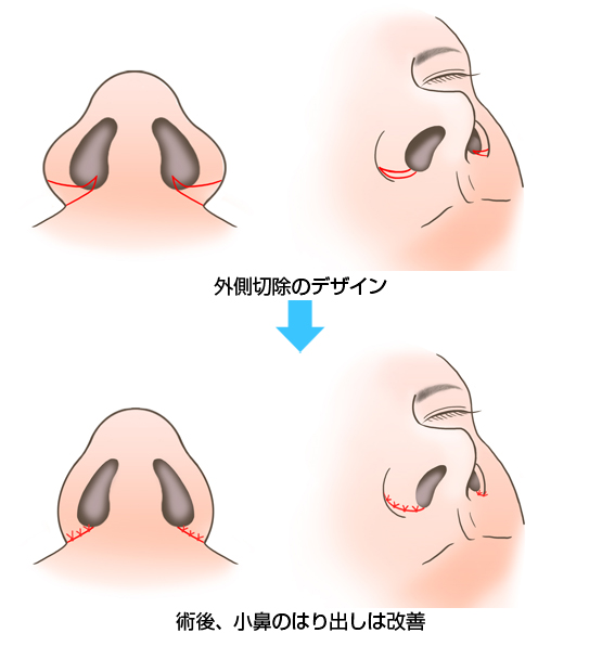 鼻翼縮小術2