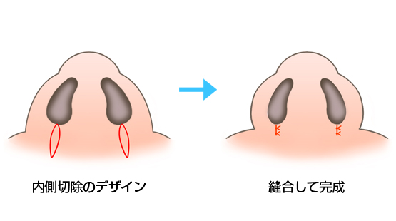 鼻翼縮小術3