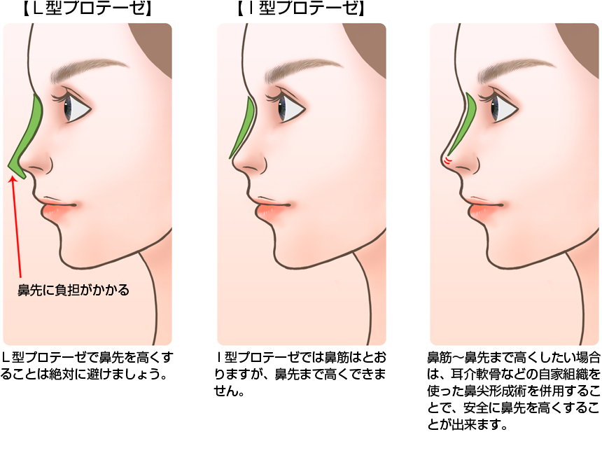 プロテーゼ挿入(医療用シリコン)による隆鼻術4