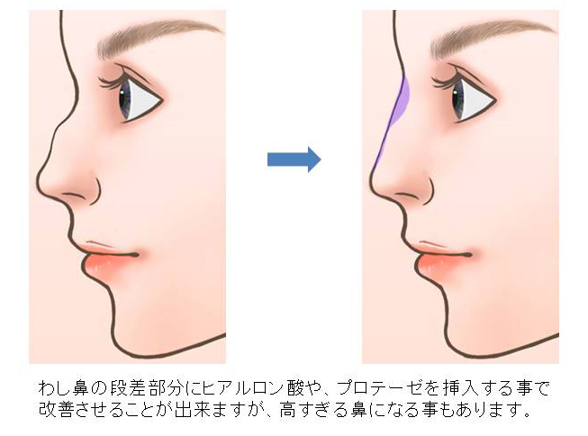 わし鼻修正術3