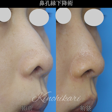  鼻孔縁下降術について