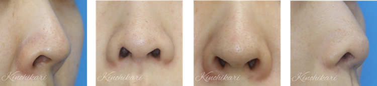  鼻孔縁下降術が適している人