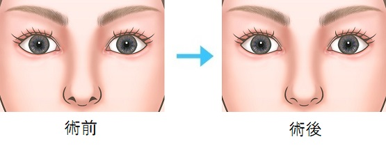  鼻孔縁下降術と鼻孔縁挙上術との違い