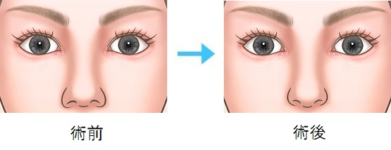  鼻孔縁下降術と鼻孔縁挙上術との違い