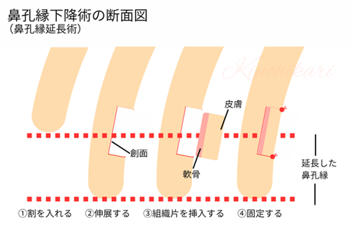  鼻孔縁下降術の断面図