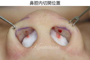 鼻腔内切開位置