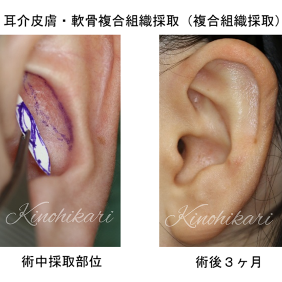 耳介皮膚・軟骨複合組織採取（複合組織採取）