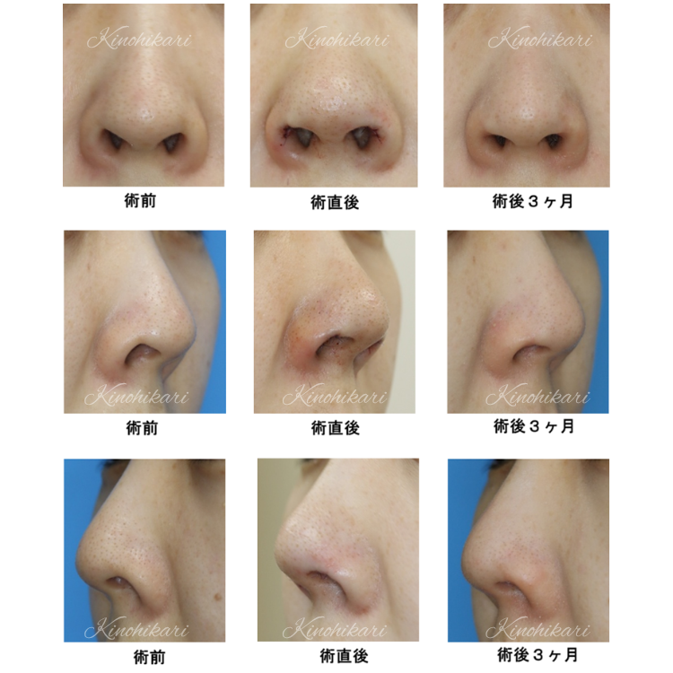 鼻孔縁下降術の術後経過の一例