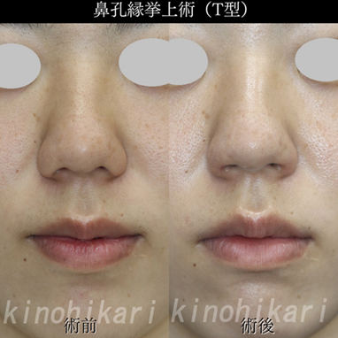  鼻孔縁が下がっている