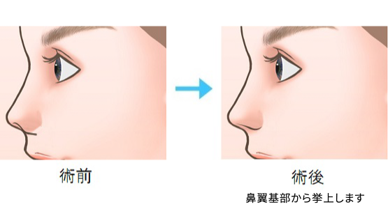 鼻孔縁挙上術I型術前術後イラスト