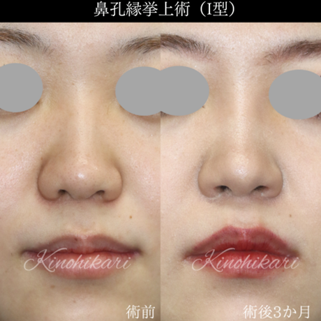 鼻孔縁挙上術I型術前術後写真