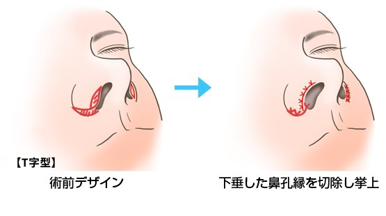 鼻孔縁挙上術T型