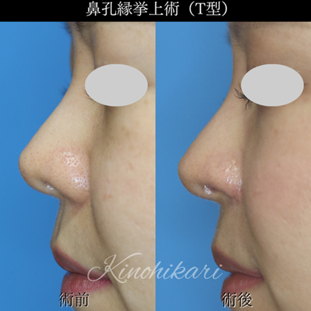 鼻孔縁挙上術T型術前術後写真