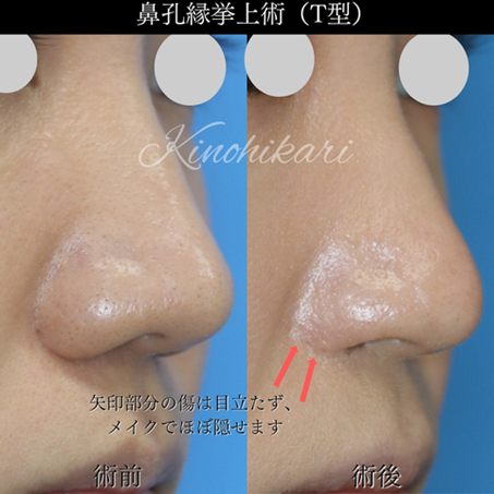 鼻孔縁挙上T型メイク前後の写真