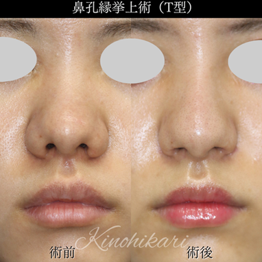  鼻の穴が大きく見える