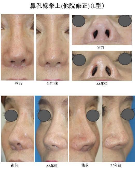鼻孔縁挙上他院修正L型