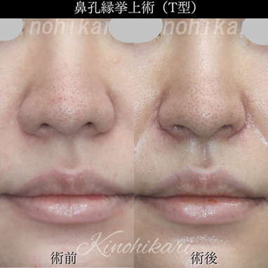  小鼻縮小をしても鼻の印象がすっきりしない