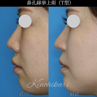  鼻中隔延長までは希望していない