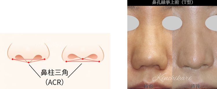 美しく見える小鼻とは