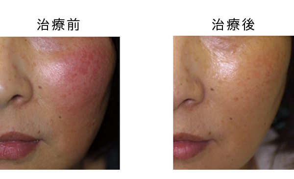 赤ら顔治療のビフォーアフター