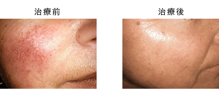 Vビーム2による治療のビフォーアフター