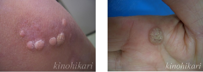 Vビーム2によるいぼ治療のビフォーアフター