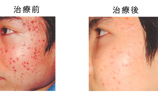 Vビーム2による赤色ニキビ・ニキビ後の赤み治療のビフォーアフター