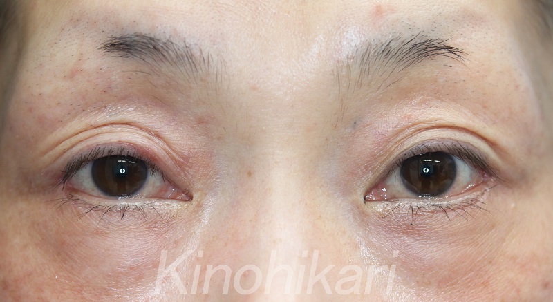 たれ目形成術 下眼瞼下制術 グラマラスアイ形成術 奈良 樹のひかり形成外科 皮ふ科