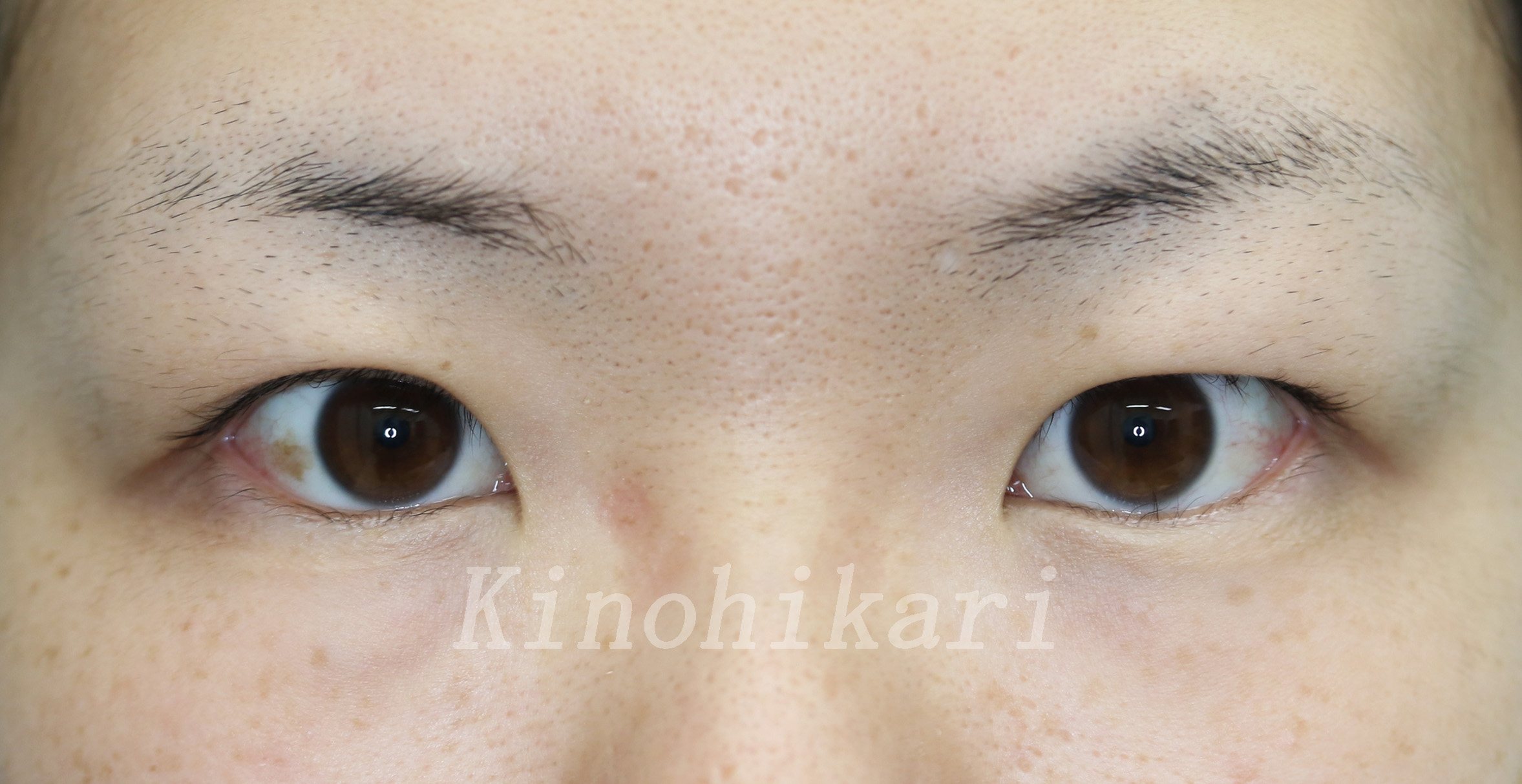 上まぶたの脱脂術 腫れぼったい目の改善 奈良 樹のひかり形成外科 皮ふ科