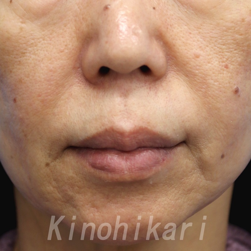 ヒアルロン酸注射でのしわ くぼみ治療 奈良 樹のひかり形成外科 皮ふ科